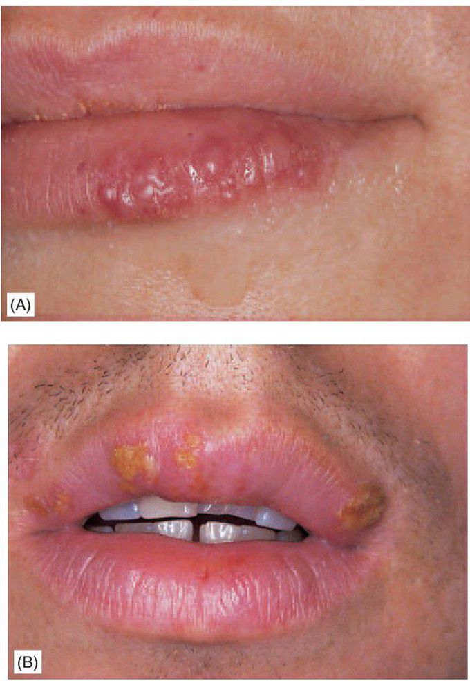 Herpes labialis.