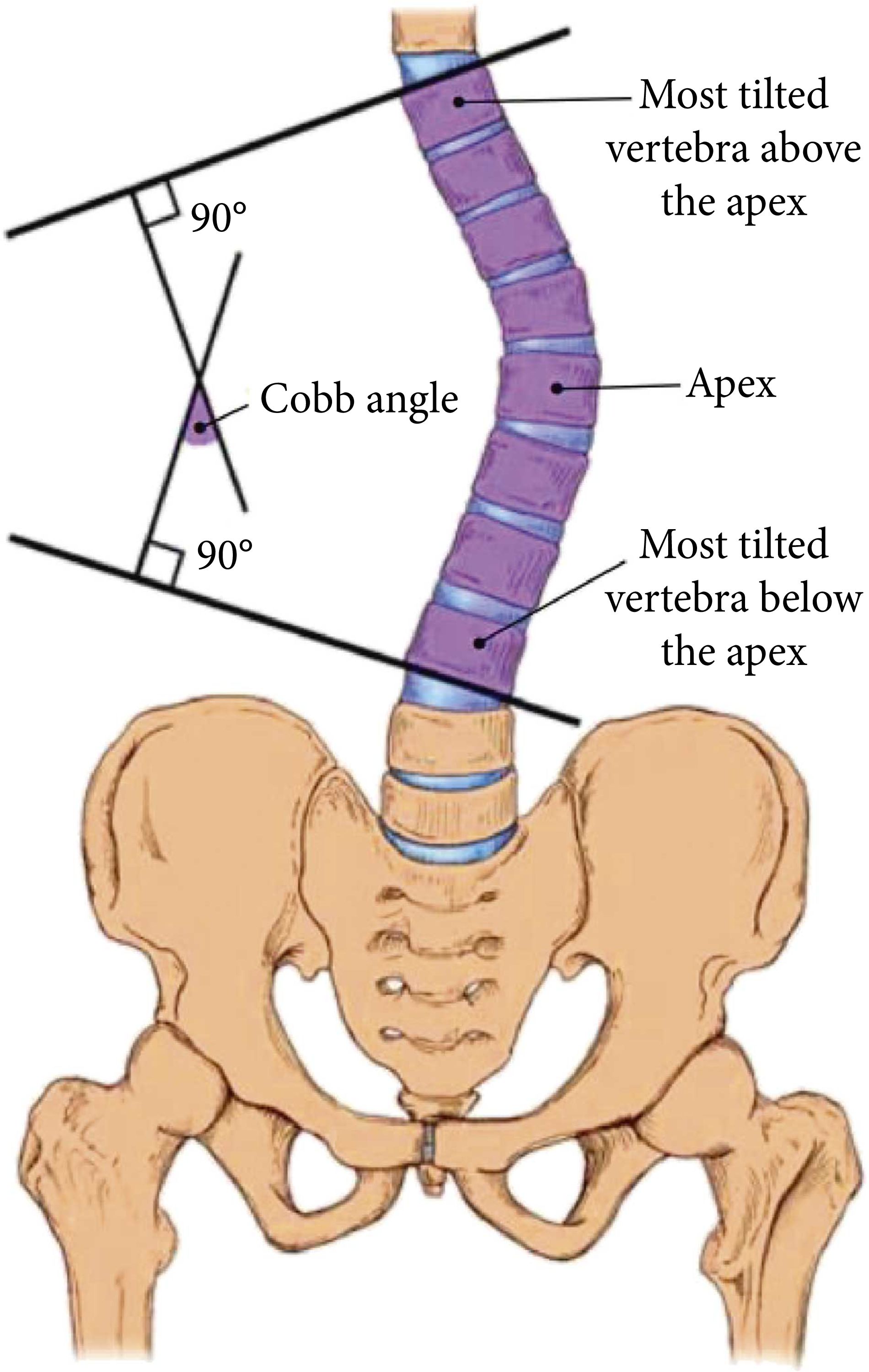 Cobb's angle (*) measurement in scoliosis. (A) Before application of