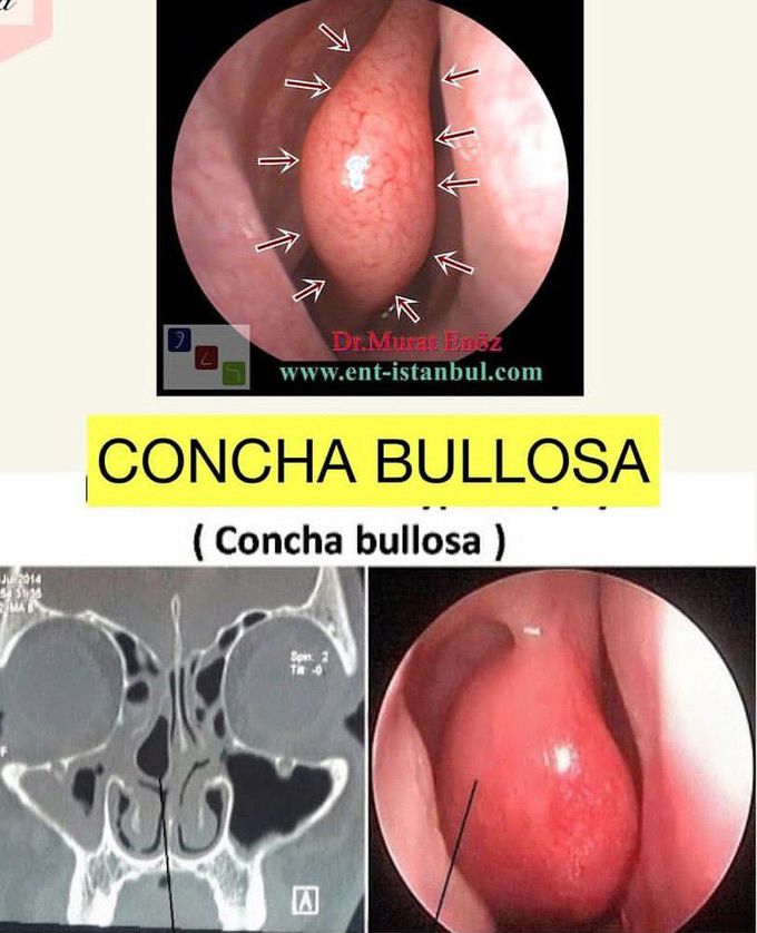 Concha Bullosa