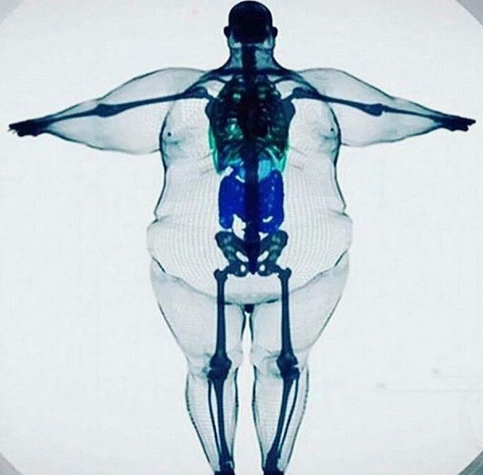 A fat man on X-ray scan 😶 like wow I’m just wondering how could this bones hold him up ??😲it seems so weak for holding all this amount of (grassa’s) fats ( I don’t mean any insult for fat people ) , what do think about this condition  ??