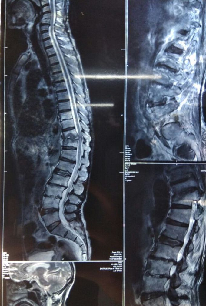 Cord compression at multiple level