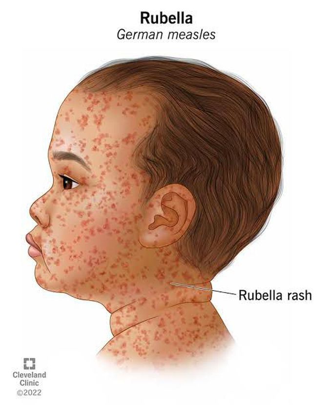 Rubella (German Measles)