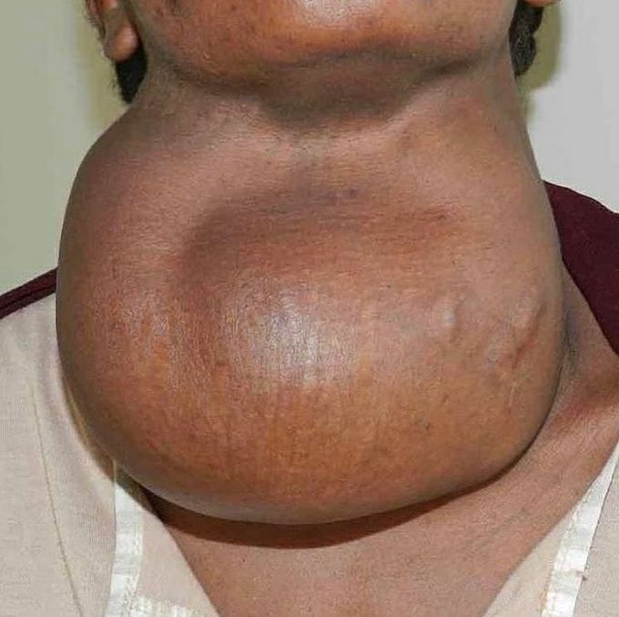 A patient with severe goiter