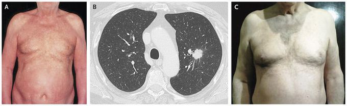 Erythroderma and a Pulmonary Nodule