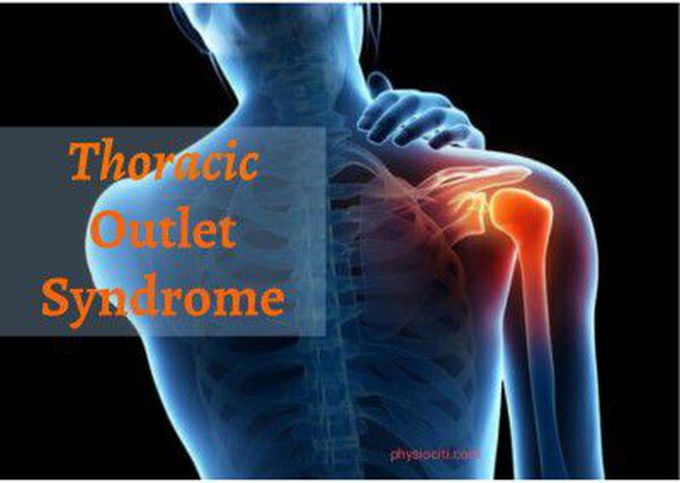 thoracic outlet syndrome exercises