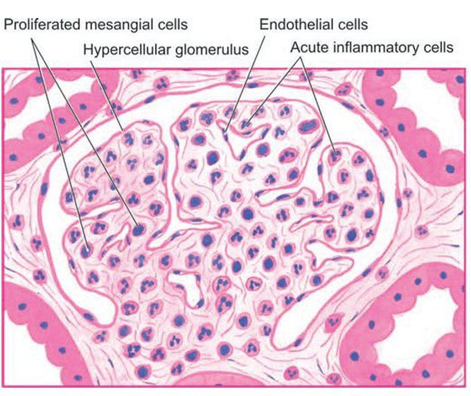 Acute post-streptococcal GN, light microscopic appearance.