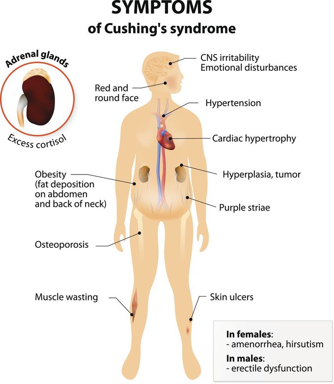 Cushing's disease