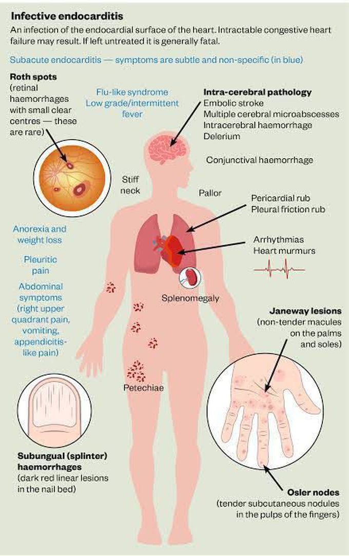 Symptoms of infective endocarditis