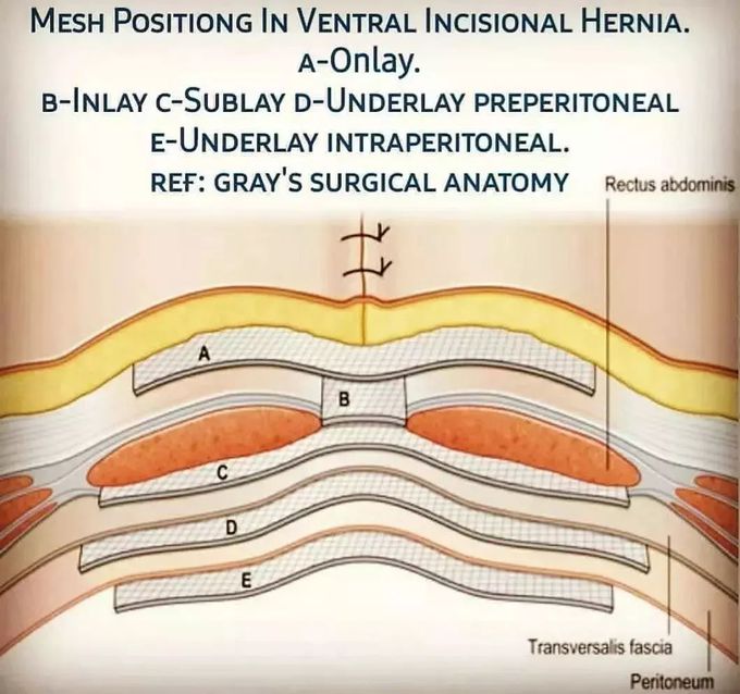 Herniorrhaphy