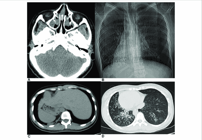 Triad of Kartagener's Syndrome