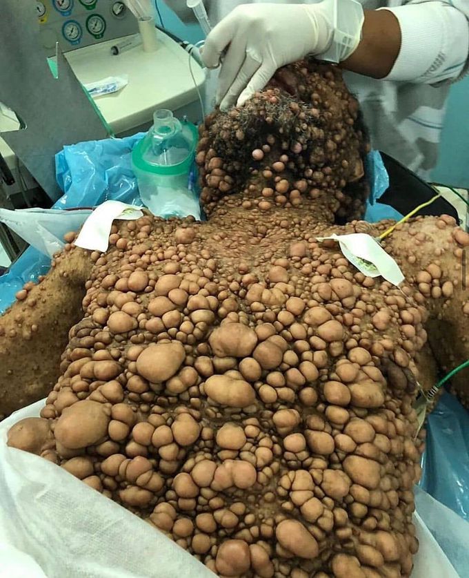Neurofibromatosis type 1