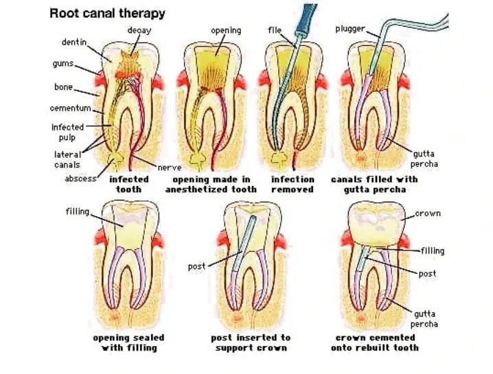 Evo root canal