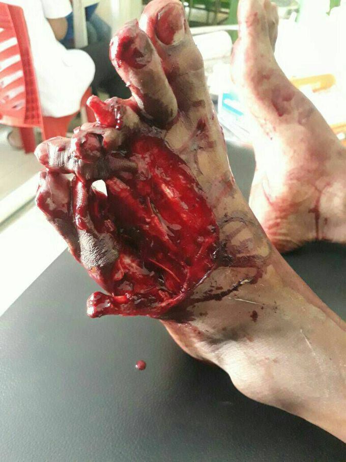 Crass injury