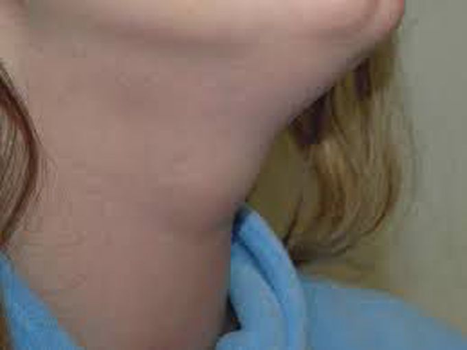 Why do thyroglossal duct cyst occur?