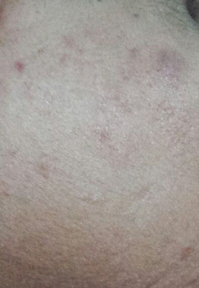 Acne