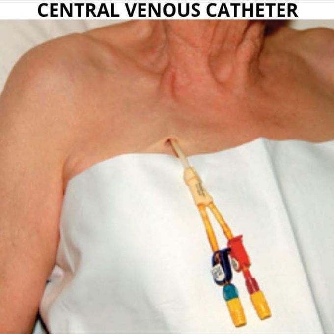 Central venous catheters( cvc )