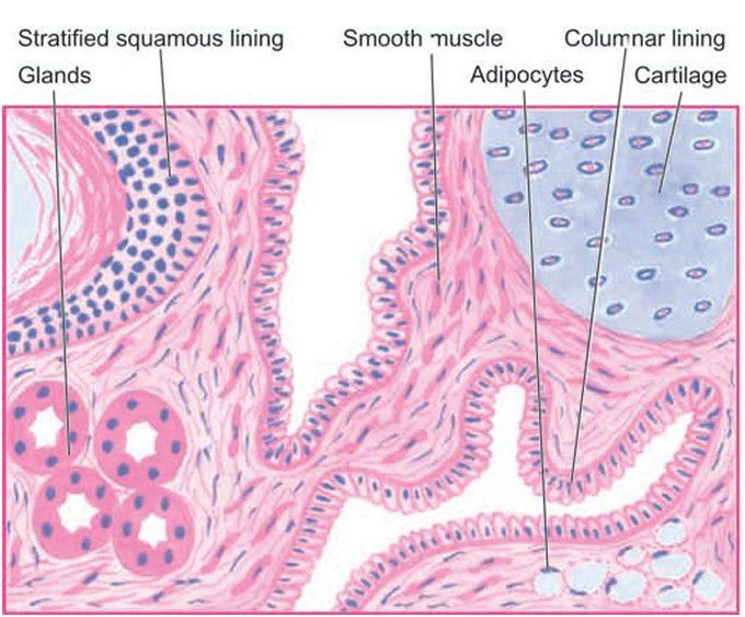 Benign cystic teratoma