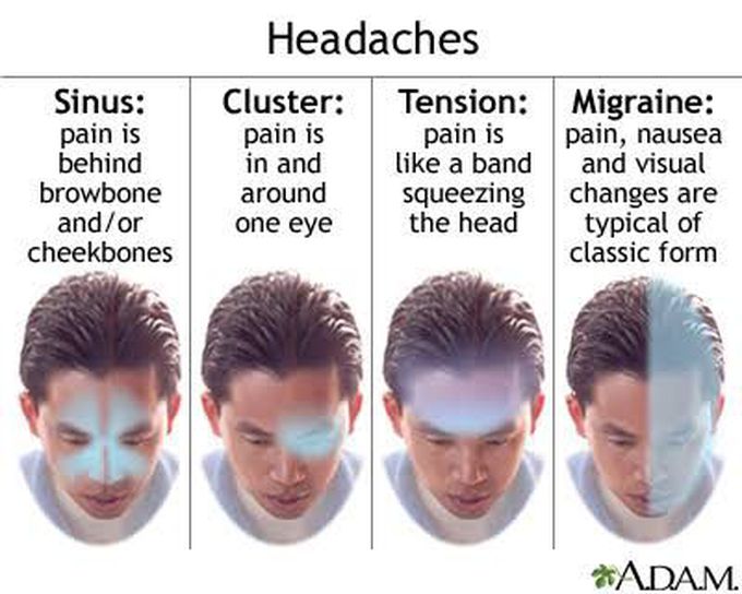 Headache types.