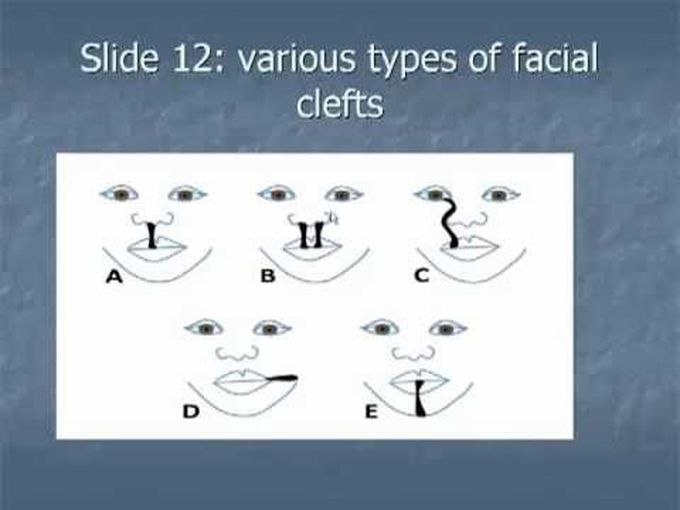 Types of facial clefts