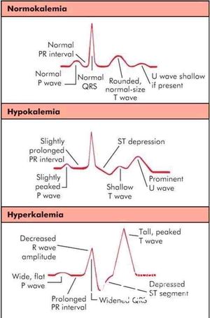 Hyperkalemia Ecg Medizzy