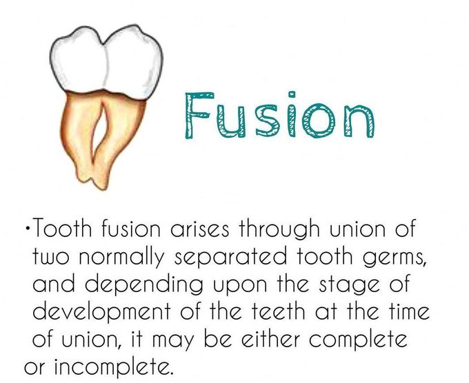 Fusion