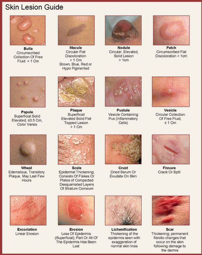 Types of skin lesions