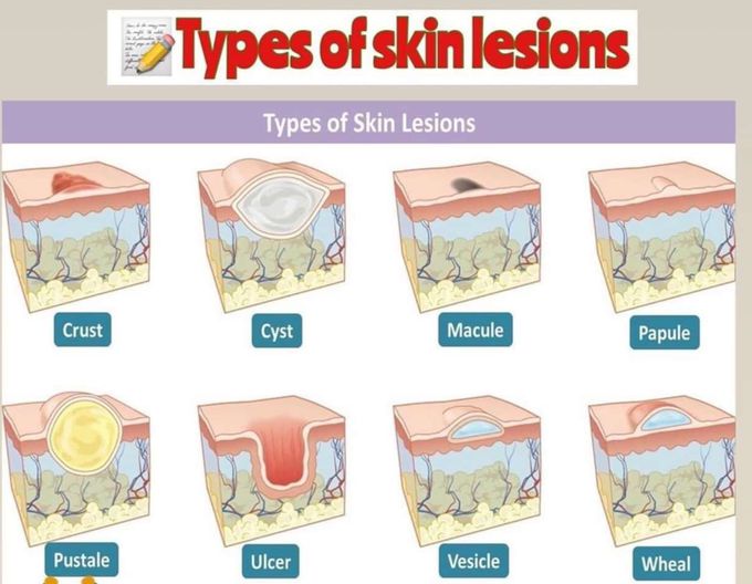 skin lesions chart