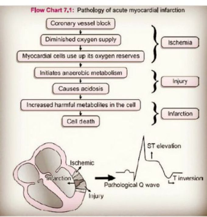 Pathology of acute myocardial infarction
