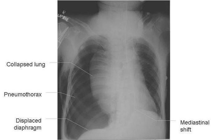 Tension pneumothorax