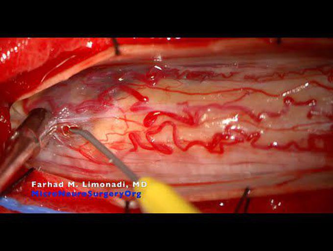 Cavernous Malformation of spinal cord: Surgical Resection