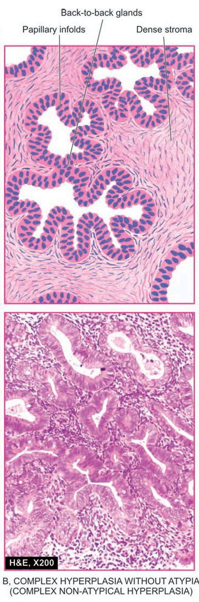 Endometrial hyperplasia