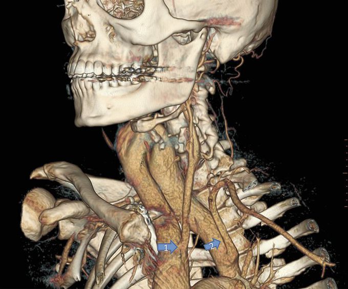 Cervical Aortic 

Arch