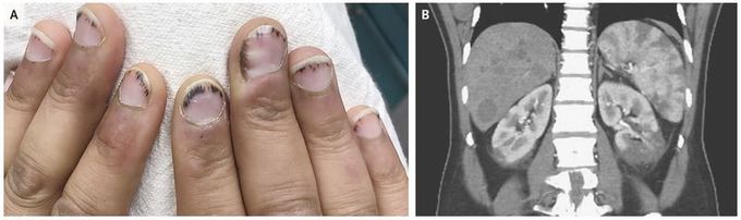 Nonbacterial Thrombotic Endocarditis