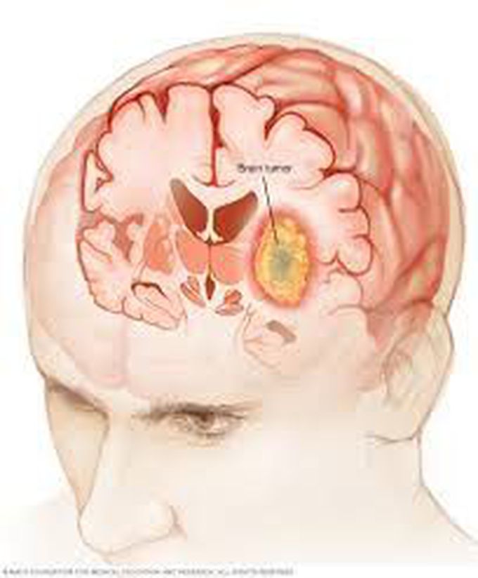 Treatment of brain tumor