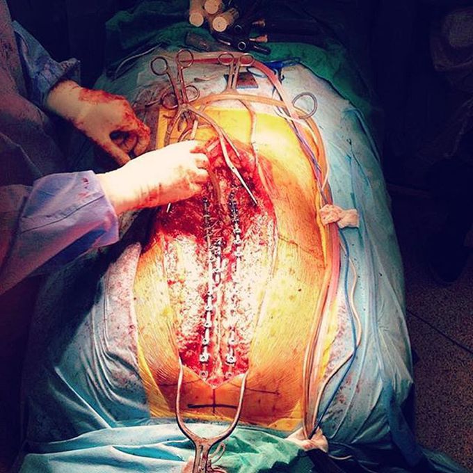 Scoliosis