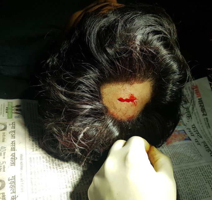 Mild 2 cm head injury