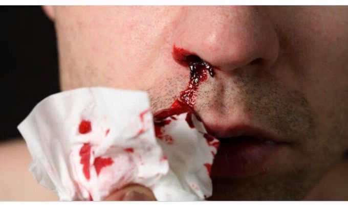 Epistaxis