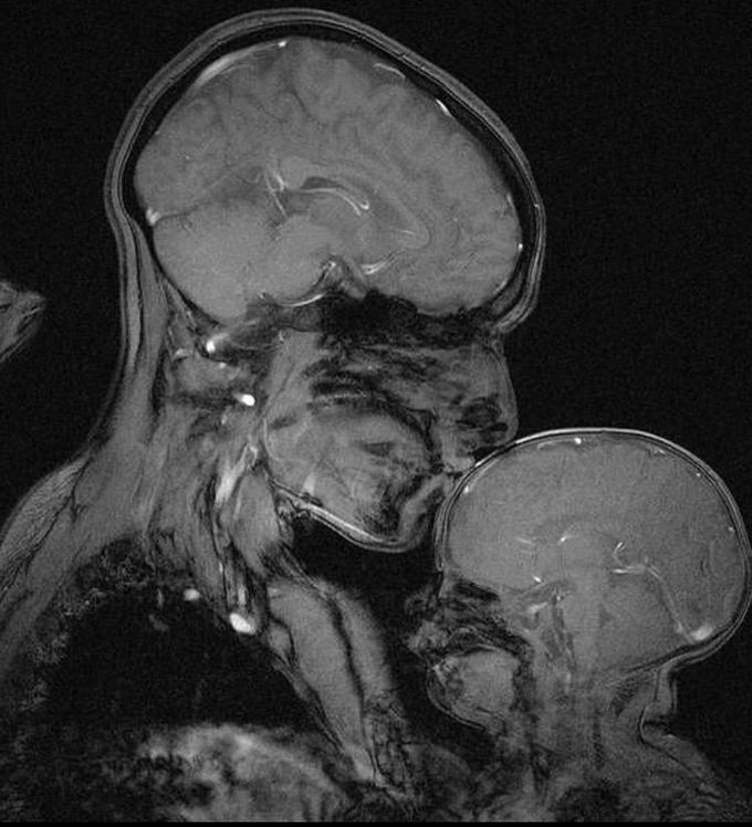 MRI