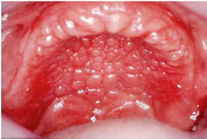 Treatment of denture stomatitis