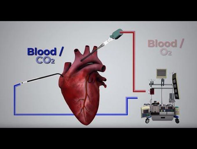 Cardiopulmonary Bypass: An Introduction