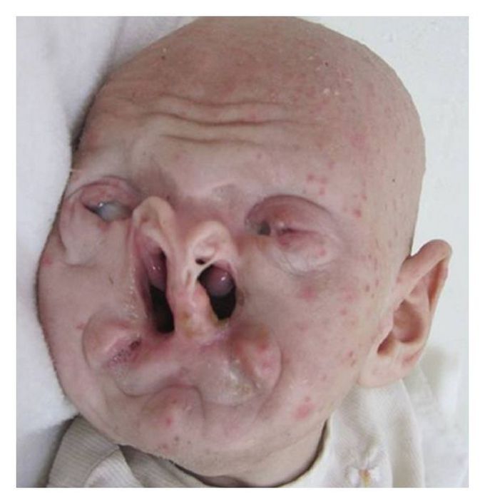 Bartsocas-Papas syndrome