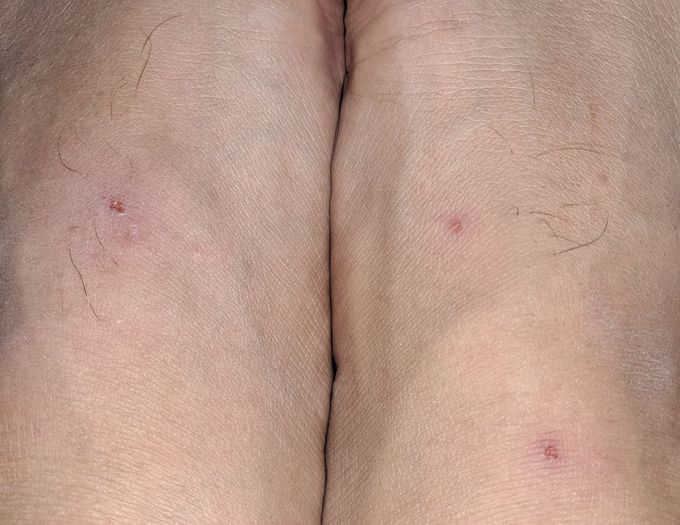 Bilateral itchy rash on the dorsum of the foot