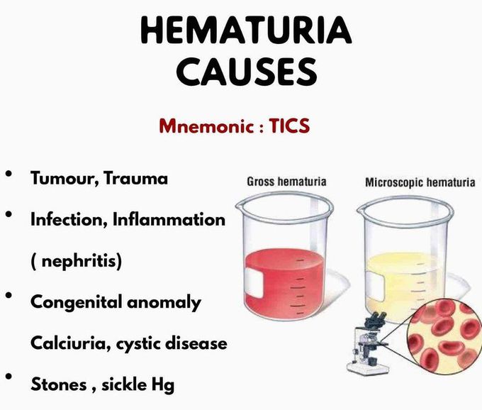 Hematuria- Causes