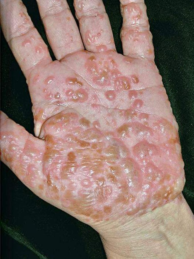 dyshidrotic eczema dyshidrotic dermatitis