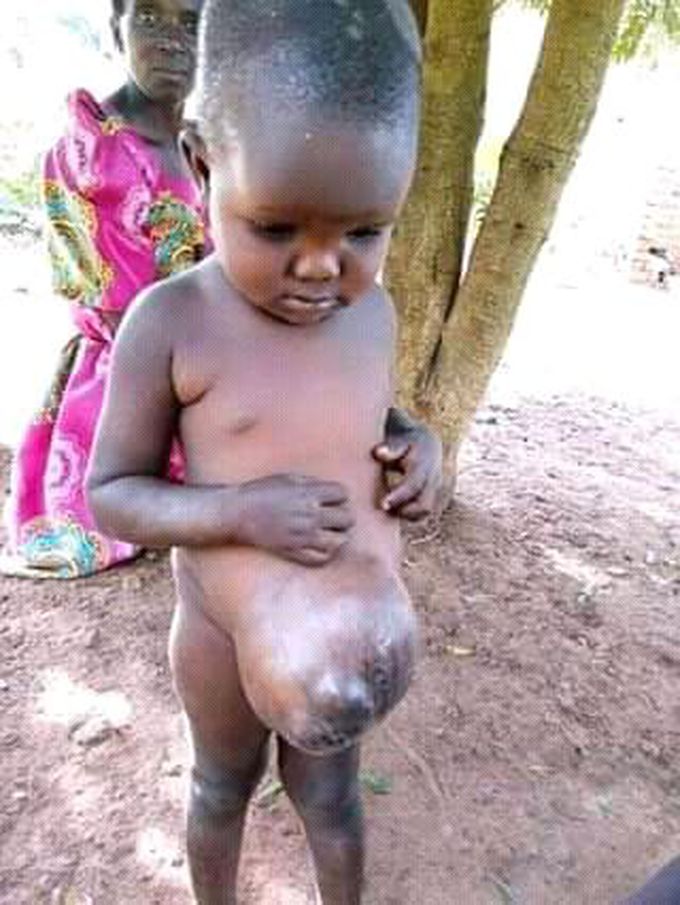 Please diagnosis, treatment, caused, prevented  and name of disease