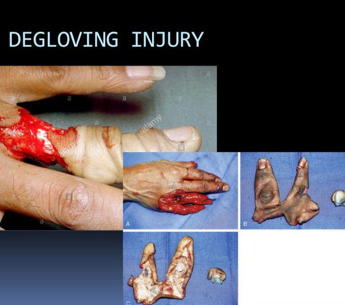 Degloving Injury