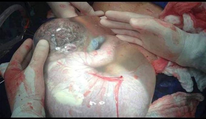 Newborn in Amniotic sac