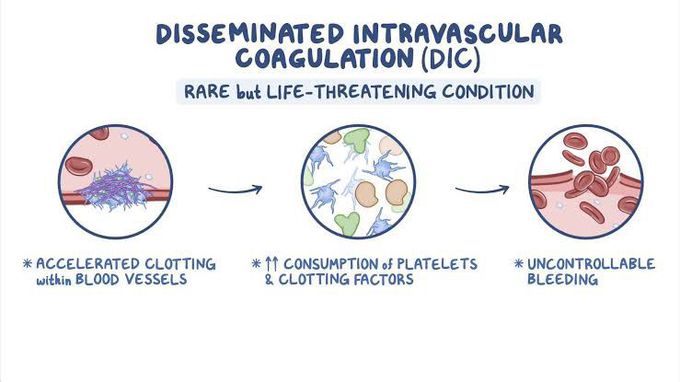 Disseminated intravascular coagulation