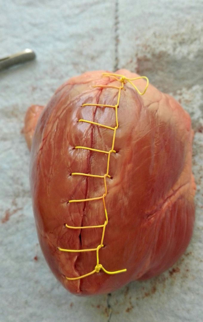 Suture on hearth