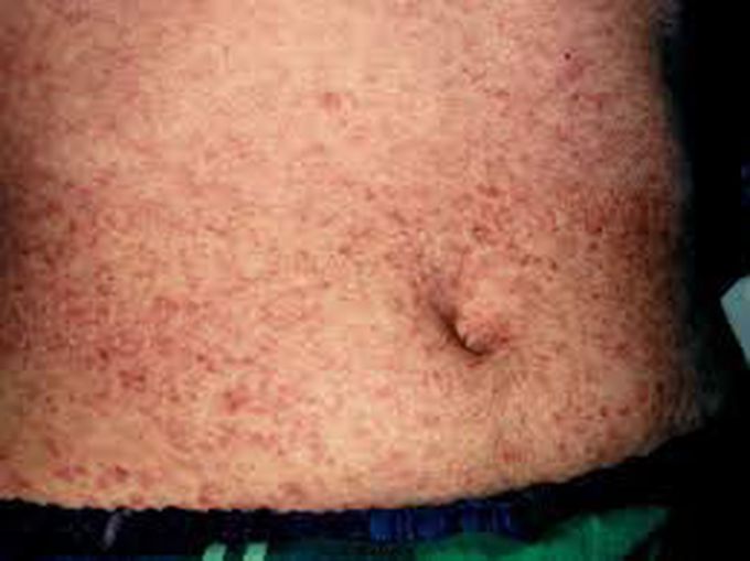 What are symptoms of viral exanthem?